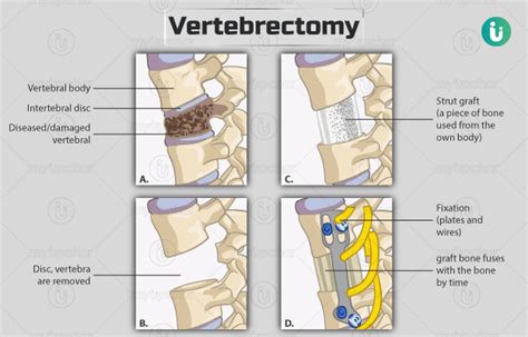 Vertebrectomy: Procedure, Purpose, Results, Cost, Price, Indications, Recovery