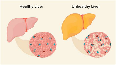 Ayurvedic Treatment for Fatty Liver Cure