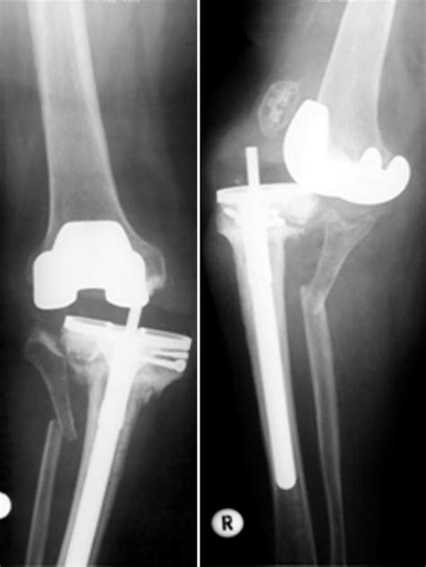 Hinged Implants for Revision Total Knee Replacement | Musculoskeletal Key