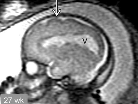 Lissencephaly Symptoms