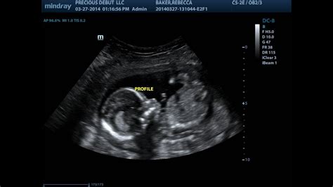 17 Week Ultrasound - YouTube