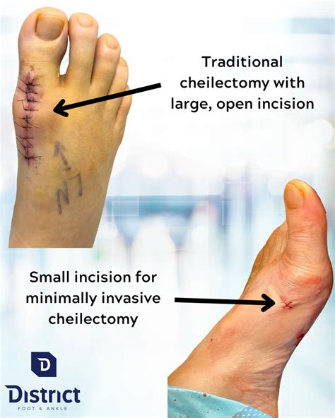 Minimally Invasive Joint Clean-Up – Cheilectomy Procedure | District Foot & Ankle