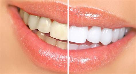 Home Remedies For Yellow Teeth - The Discover Reality