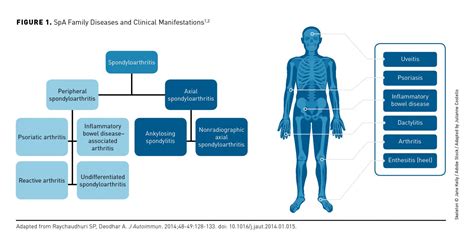 axial spondyloarthritis diagnosis