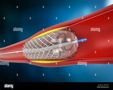 3d rendering balloon angioplasty procedure with stent in vein Stock ...