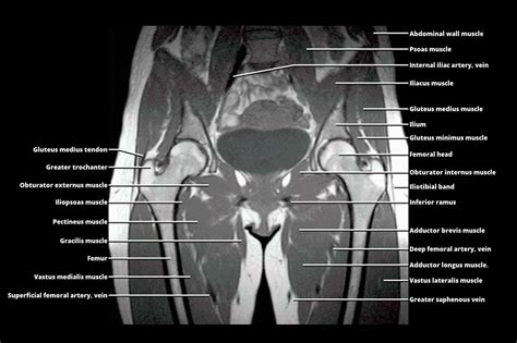 MRI - PELVIS