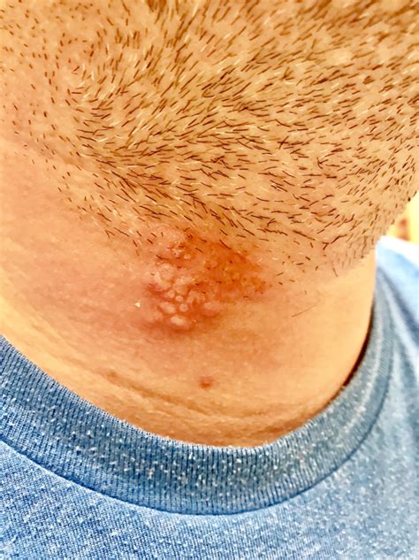 What’s Causing This Man’s Folliculitis Barbae? | Consultant360