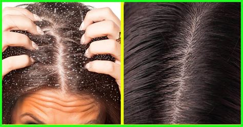 Symptoms Of Dandruff, Its Types, Causes, And How To Treat It