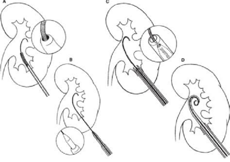 Percutaneous Nephrostomy