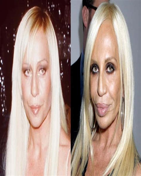 20 Of The Worst Celebrity Plastic Surgery Disasters