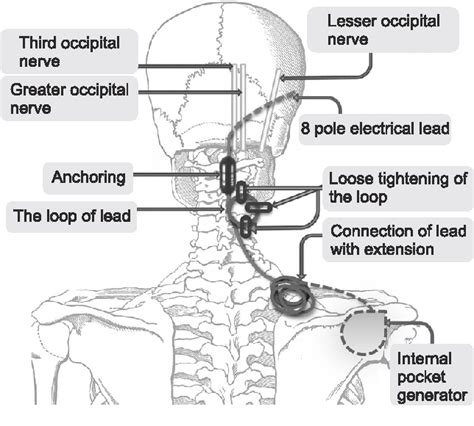 Figure 2 from Occipital nerve stimulation in a patient with an ...