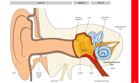 what is glue ear? — ent4kids