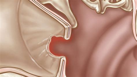 How to Treat a Perforated Ear Drum | Ear Problems - YouTube