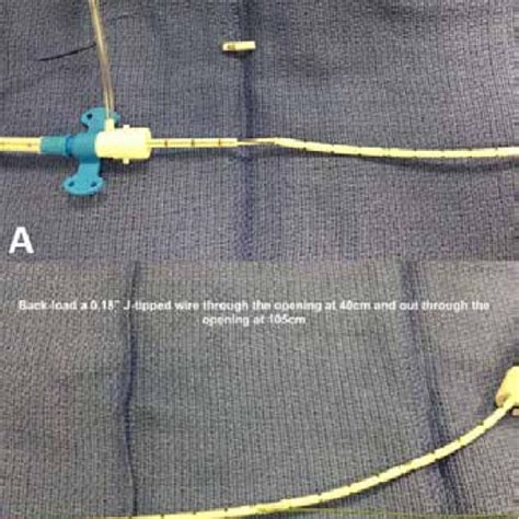 (PDF) Procedure for Changing an Impella Device While Maintaining Guide ...