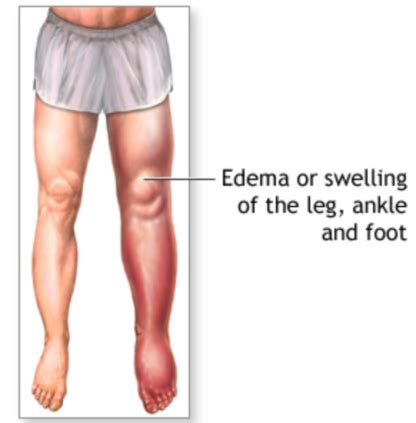 Best Compression Socks and Stockings for Edema - ComproGear