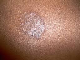 Ringworm (Body)