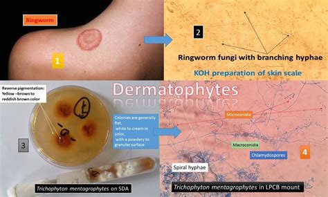 Dermatophytes: Introduction, Infection and its Laboratory Diagnosis