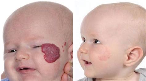 Hemangiomas - Dell Children's Craniofacial Team of Texas