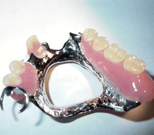 metal frame denture design - adelaidadowker