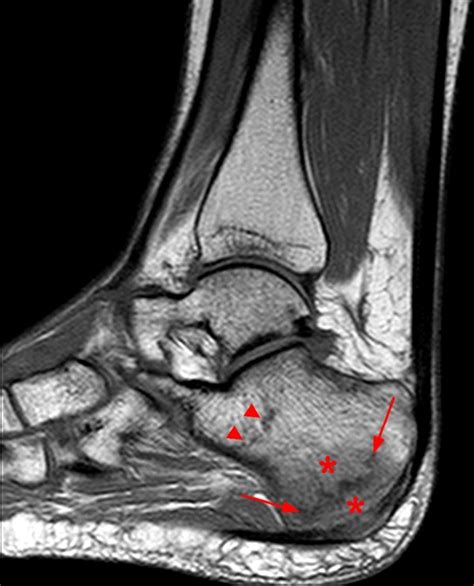 Stress fractures in the foot and ankle