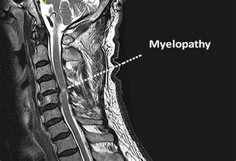 Myelopathy - Causes, Symptoms & Treatment | Bonati Spine Institute