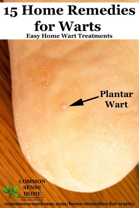 Stages Of A Plantar Wart