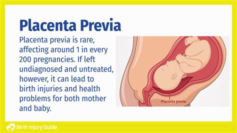 Placenta Previa: Causes, Risk Factors, Treatment | Birth Injury Guide