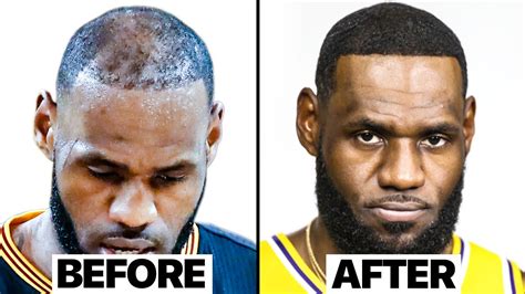 LeBron James Hair Transplant | Surgeon Reacts :: GentNews