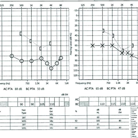 Audiogram showing bilateral mixed hearing loss. | Download Scientific Diagram