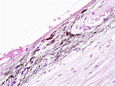 ocular melanocytosis | EyePath