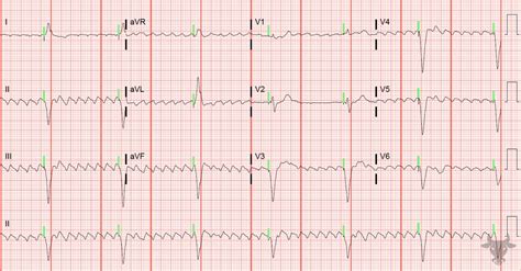 Paced Rhythms | ECG Stampede