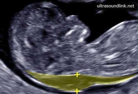 thick nuchal fold shows high probability of chromosomal abnormality......Shows fetal ultrasounds ...