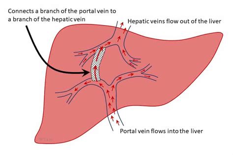 Transjugular Intrahepatic Portosystemic Shunt (TIPS) - American Liver ...