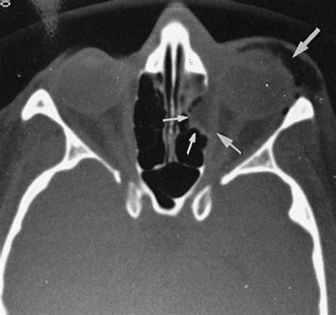 Facial Trauma | Radiology Key