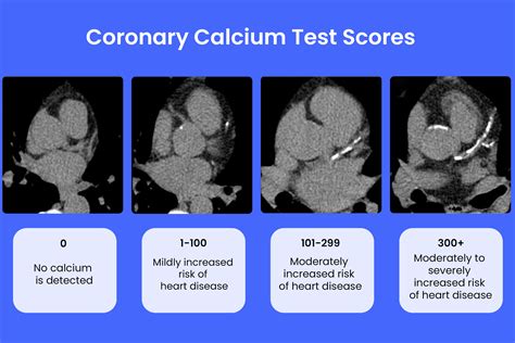 Coronary Calcium Test: What Is It, Procedure, and Results