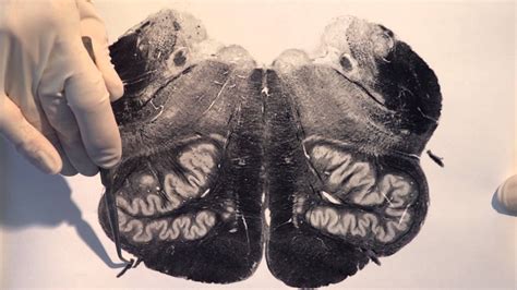 Neuroanatomy Video Lab - Brain Dissections: Brain Stem & Reflexes - The Mind Voyager