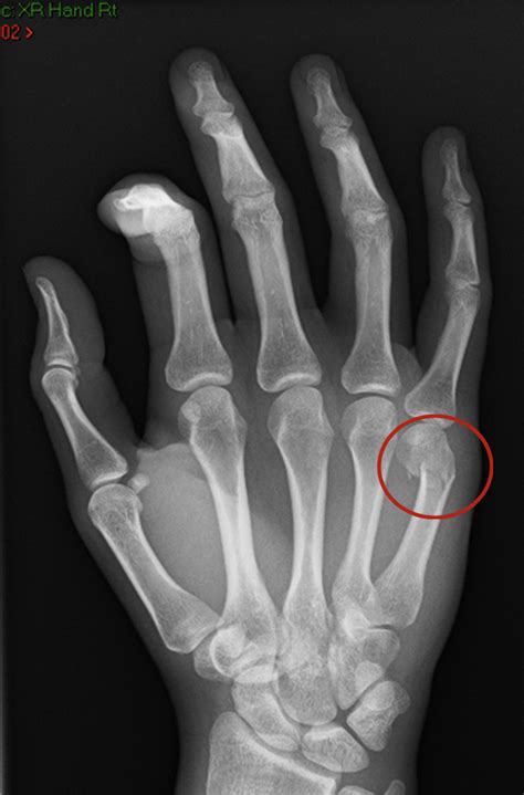 Metacarpal Fractures – Fife Virtual Hand Clinic