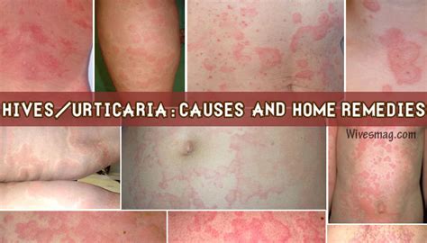 Symptoms, Causes, Home remedies & treatments for Urticaria or Hives