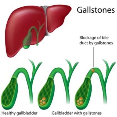 Gallstones: Symptoms & natural remedies — Health & Wellness — Sott.net