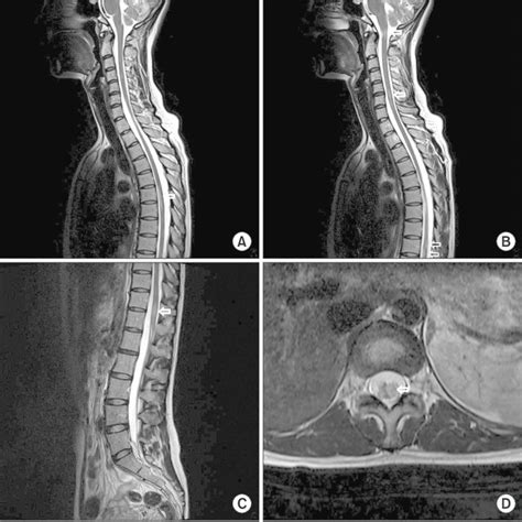 Gadolinium contrast brain magnetic resonance imaging (MRI) imaging ...