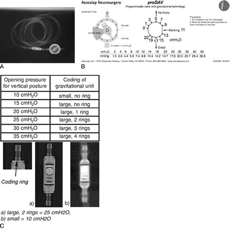 Programmable CSF Shunt Valves: Radiographic Identification and ...