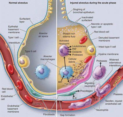 Study Identifies Risk Factors for Physical Decline Among ARDS Survivors ...