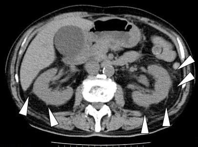 Perirenal fat stranding is not a powerful diagnostic tool for acute py | IJGM