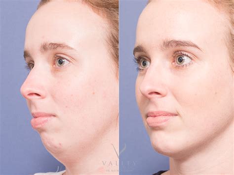 Chin Surgery Brisbane | Genioplasty | Valley Plastic Surgery