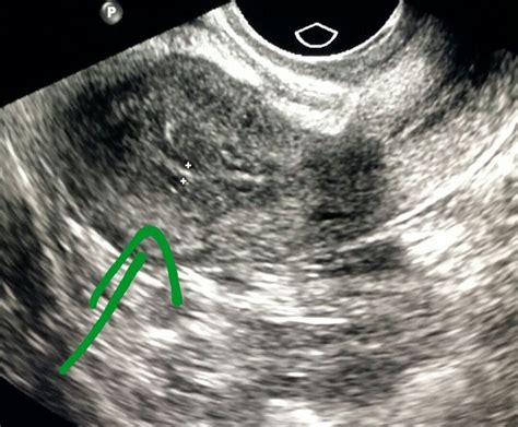 #Ultrasound of the #pelvis shows a #normal #uterus. #radiologist #radiology | Women's Health ...