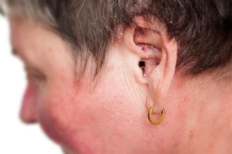 Psoriasis in the ears: Treatment and symptoms
