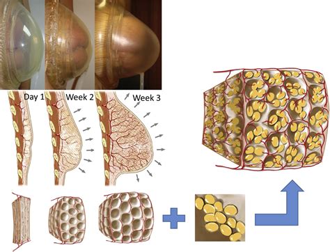 Tissue-Engineered Autologous Breast Regeneration with Brava®-Assisted ...