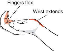 Tenodesis | definition of tenodesis by Medical dictionary