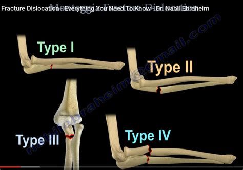 Monteggia Fracture Dislocation — OrthopaedicPrinciples.com