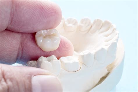 Dental Crown Alternatives: A Closer Look at Options for Enhanced Oral ...